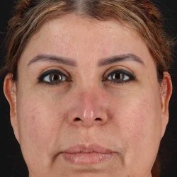Neck Lift Before & After Patient #1709