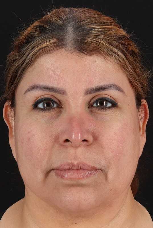 Neck Lift Before & After Patient #1709