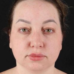 Neck Lift Before & After Patient #1720