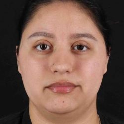 Neck Liposuction Before & After Patient #1753