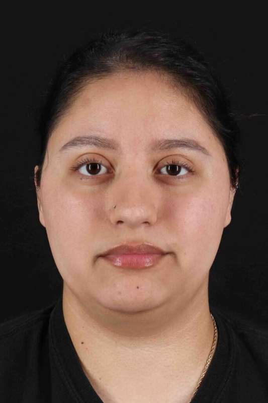 Neck Liposuction Before & After Patient #1753
