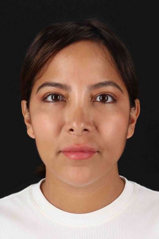 Neck Liposuction Before & After Patient #1764