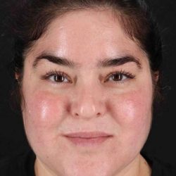 Neck Liposuction Before & After Patient #1775
