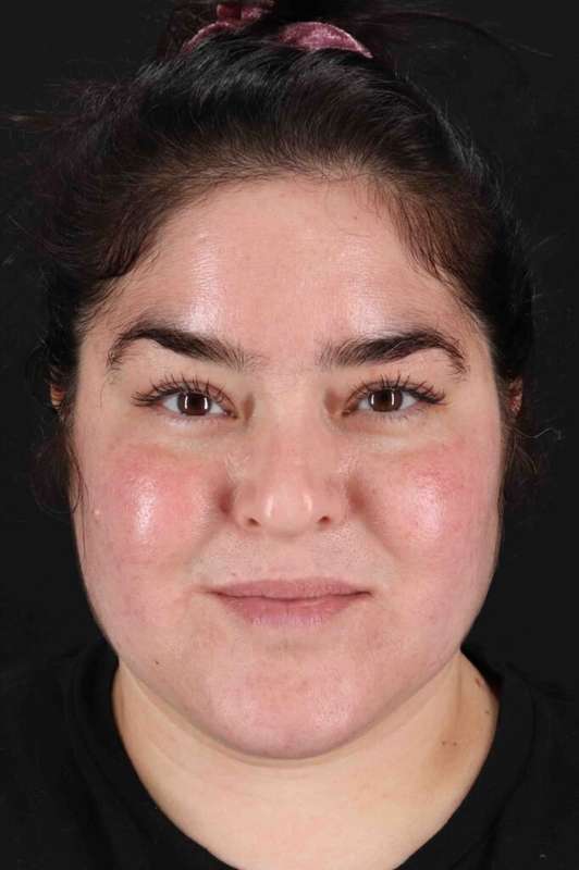 Neck Liposuction Before & After Patient #1775
