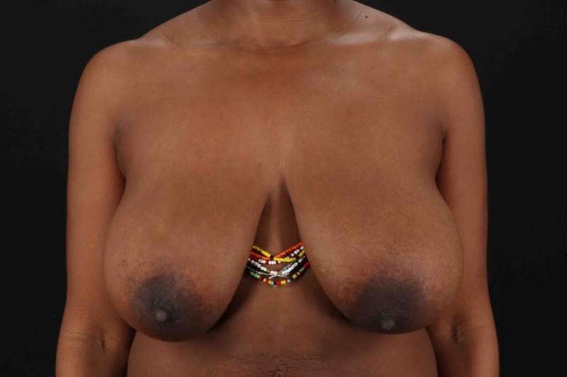 Breast Reduction with Lift Before & After Patient #883
