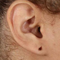 Earlobe Repair Before & After Patient #1791