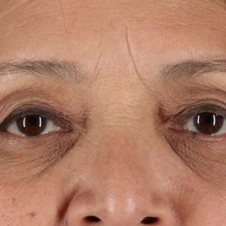Eyelid Surgery Before & After Patient #1803
