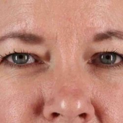 Eyelid Surgery Before & After Patient #1814