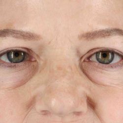 Eyelid Surgery Before & After Patient #1825