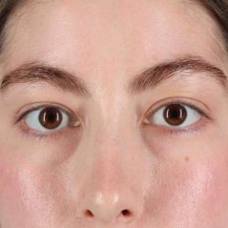 Eyelid Surgery Before & After Patient #1836