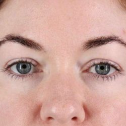 Eyelid Surgery Before & After Patient #1847