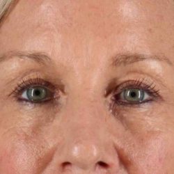 Eyelid Surgery Before & After Patient #1858