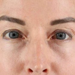 Eyelid Surgery Before & After Patient #1869