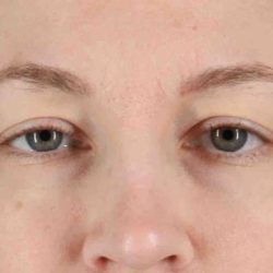 Eyelid Surgery Before & After Patient #1880