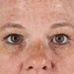 Eyelid Surgery Before & After Patient #1891