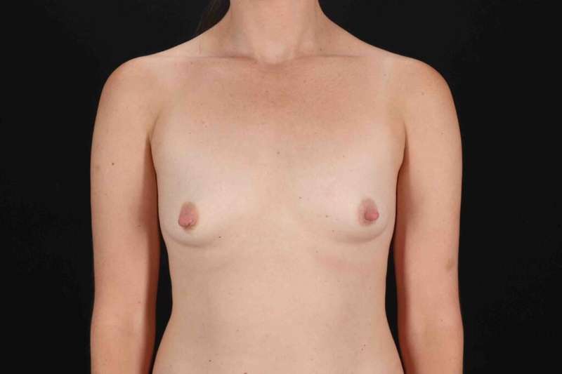 Breast Augmentation with Fat Transfer Before & After Patient #784