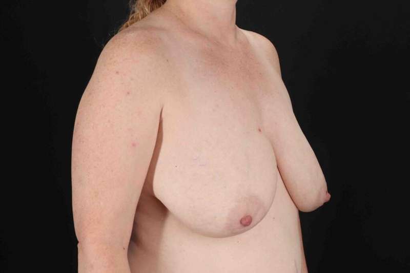 Breast Augmentation with Fat Transfer Before & After Patient #795