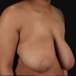 Breast Reduction with Lift Before & After Patient #905