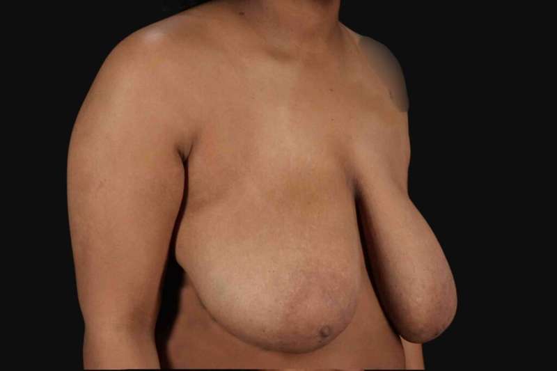 Breast Reduction with Lift Before & After Patient #905