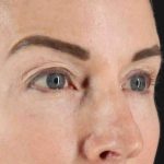 CO2 Laser Before & After Patient #2070