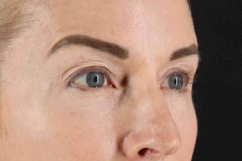 Laser Before & After Patient #2070