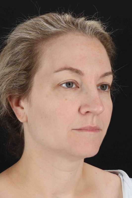 Laser Before & After Patient #2081