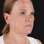 CO2 Laser Before & After Patient #2103