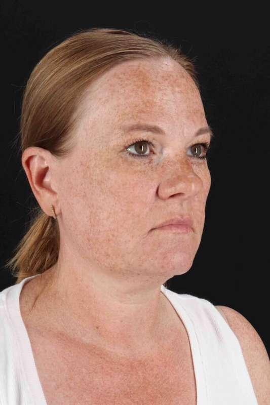 Laser Before & After Patient #2103