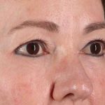 CO2 Laser Before & After Patient #2114