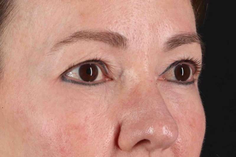 Laser Before & After Patient #2114