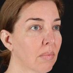 CO2 Laser Before & After Patient #2136