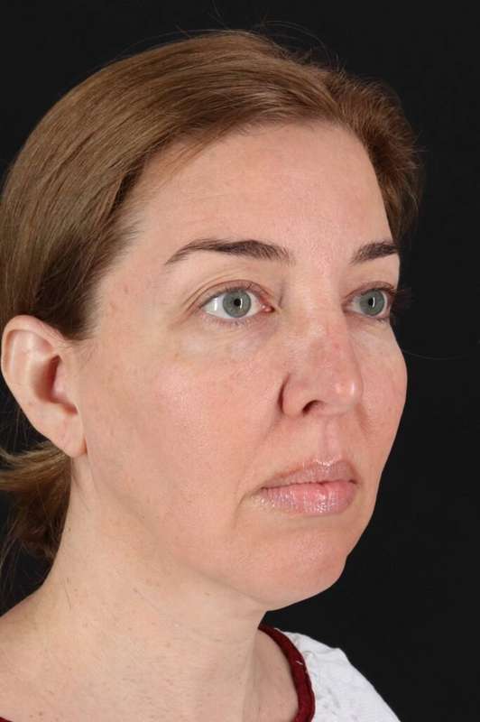 Laser Before & After Patient #2136