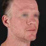 CO2 Laser Before & After Patient #2158