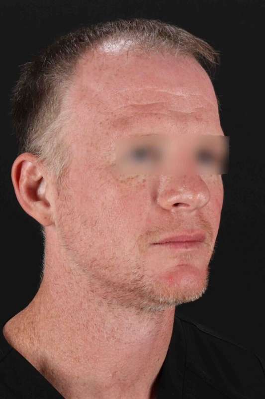 Laser Before & After Patient #2158