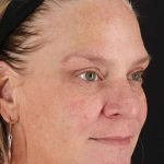 Chemical Peel Before & After Patient #2169