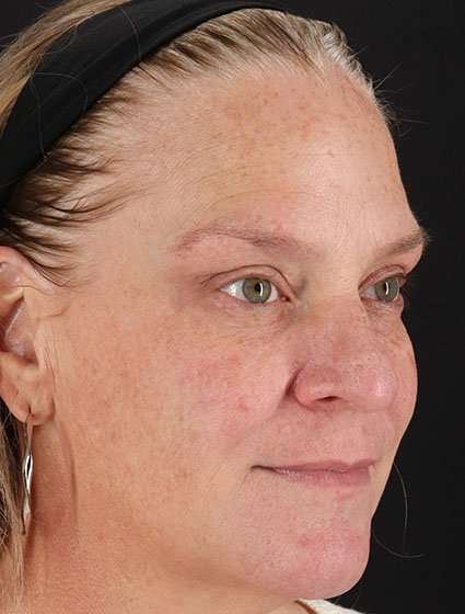 Chemical Peel Before & After Patient #2169