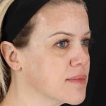 Chemical Peel Before & After Patient #2180