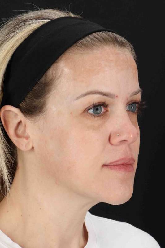 Chemical Peel Before & After Patient #2180