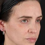 Chemical Peel Before & After Patient #2202