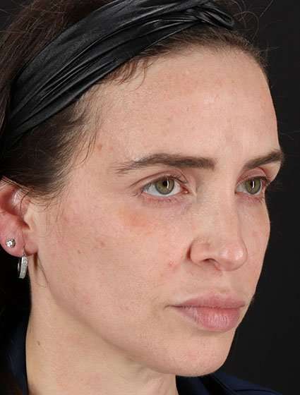 Chemical Peel Before & After Patient #2202