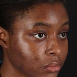Chemical Peel Before & After Patient #2213
