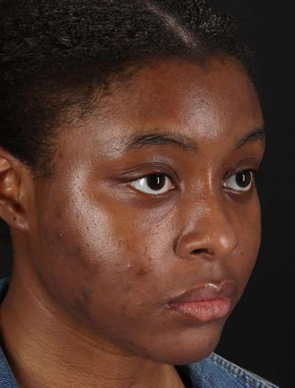 Chemical Peel Before & After Patient #2213