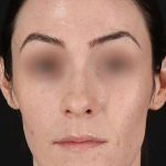 Cosmetic Injectables Before & After Patient #2236