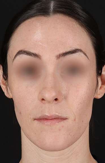 Cosmetic Injectables Before & After Patient #2236