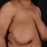 Breast Reduction with Lift Before & After Patient #928