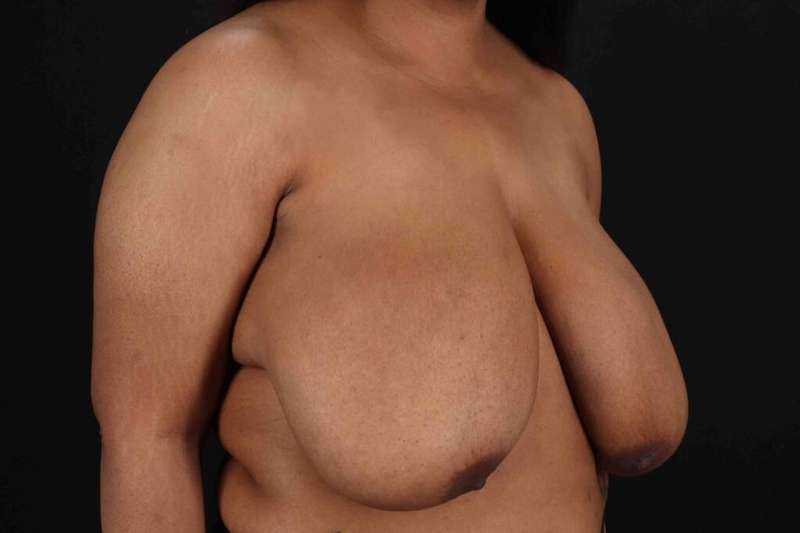 Breast Reduction with Lift Before & After Patient #928