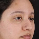 Cosmetic Injectables Before & After Patient #2253