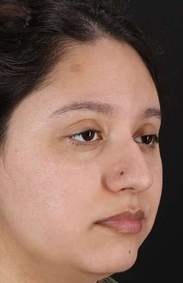 Cosmetic Injectables Before & After Patient #2253