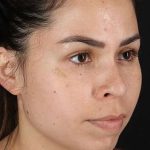 Cosmetic Injectables Before & After Patient #2264