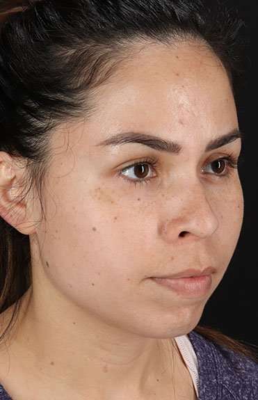 Cosmetic Injectables Before & After Patient #2264